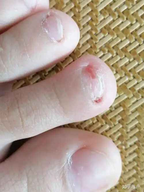 大脚趾甲有一条特别深的横纹,看起来跟裂开了一样,想请教一下这是怎么
