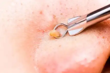 满脸痘痘用爆米花装置挤痘痘黑头照片