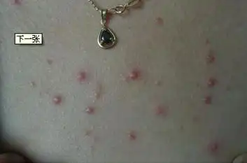 丘疱疹(疾病)为丘疹顶端有小疱者.