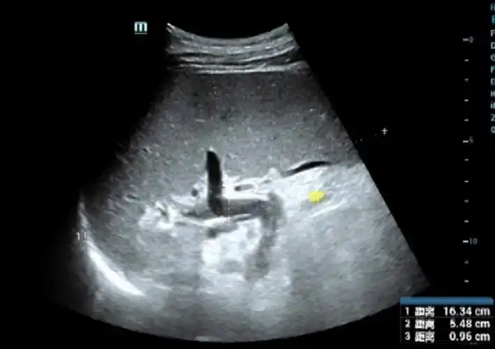 脾大,有麻烦,三度划分要拿准