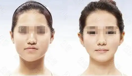 偏颌做正颌手术前后对比图