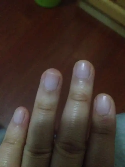 孕五个多月,手指甲盖上月牙边处发紫,什么原因呢