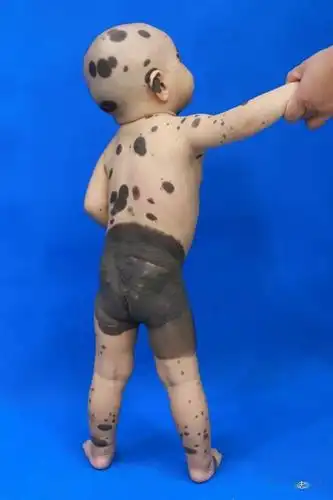 其实类似这样患有巨大黑色素痣的患者还有很多,只是这次我们把目光