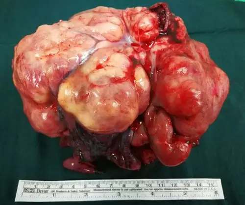 友谊医院成功切除一巨大肺部恶性肿瘤