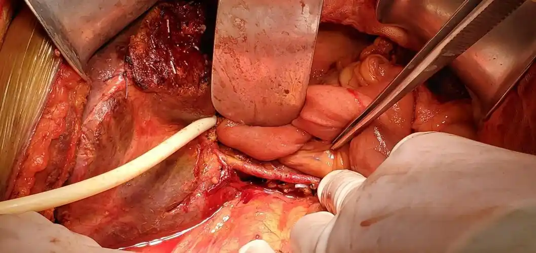 老年患者诊断胆总管癌合并肝内胆管癌是否能一次手术解决