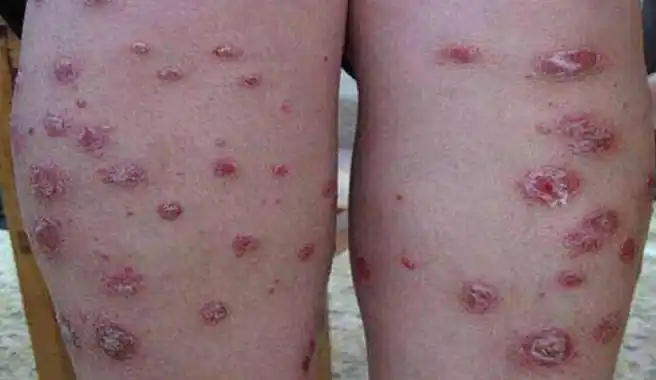 感染梅毒多久出现症状