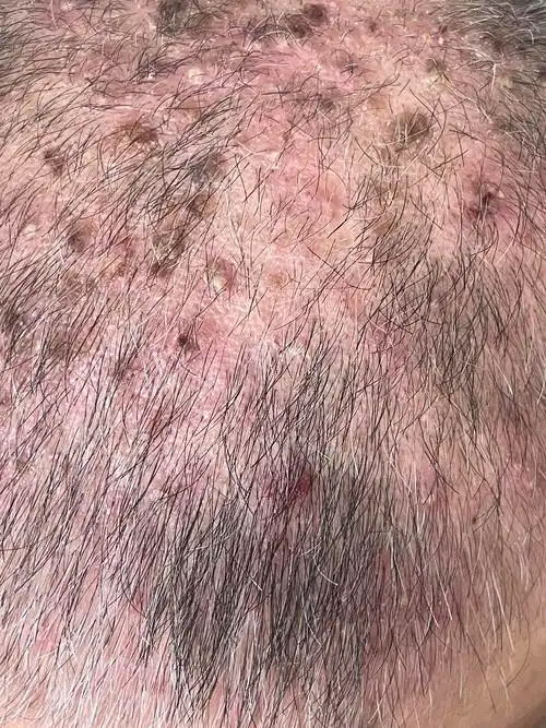 我头皮的毛囊炎为啥总是反复