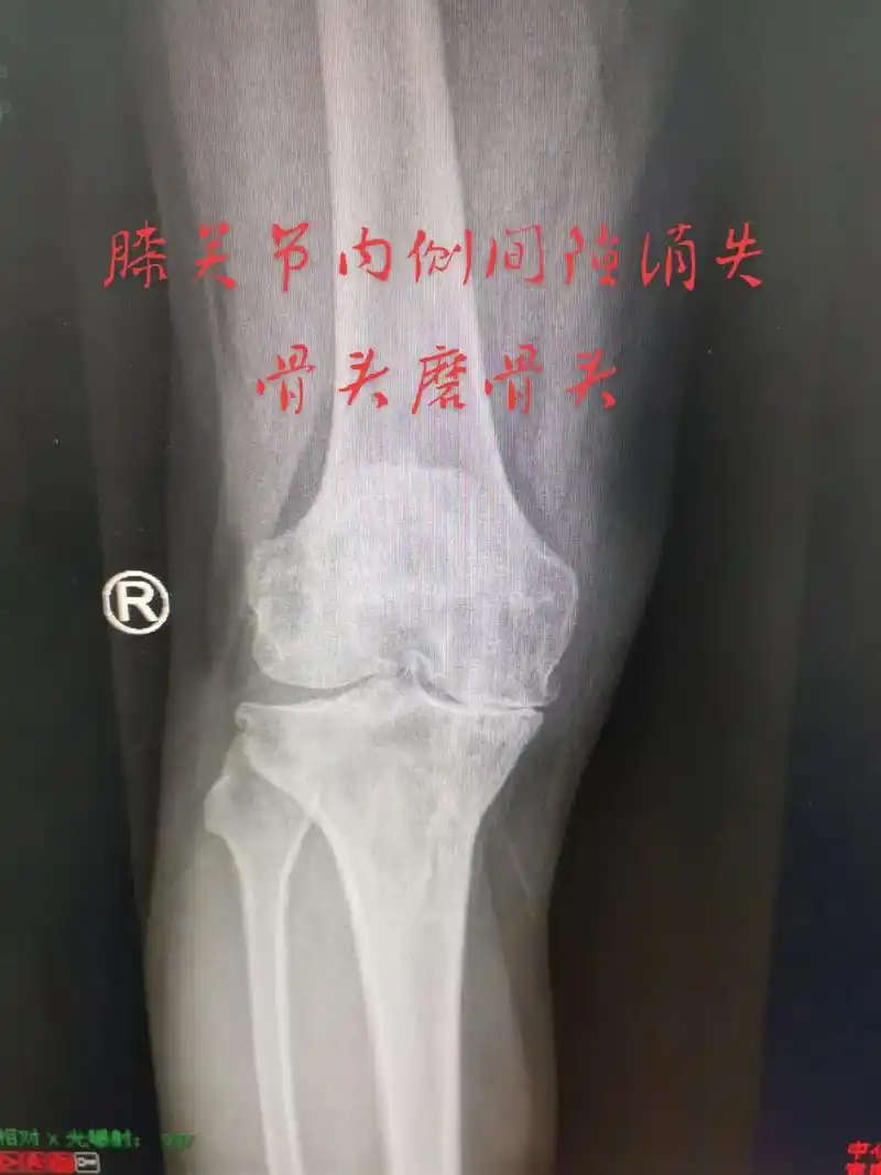 第一张图片是前内侧骨关节炎骨磨骨阶段,如果膝关节疼痛,拍x线 - 抖音