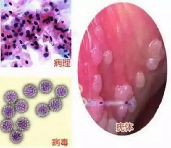 羞羞的地方长了小肉疙瘩, 不会是得了「菜花病」吧?