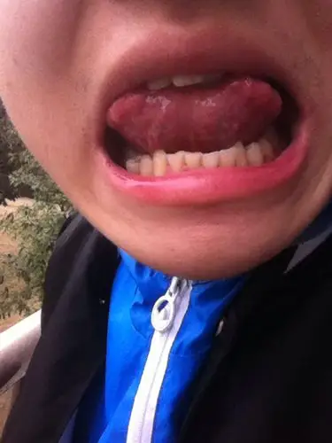 舌根上有疙瘩最近也有点累看我的舌头