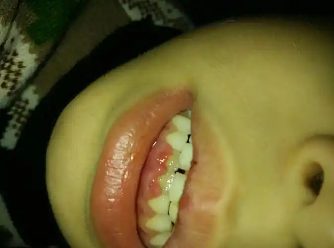男孩8岁,牙龈肿,还有脓水,嘴唇舌头上还有溃疡,怎么回事?