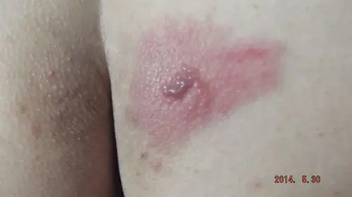 屁股的一侧长了红色水泡,水泡周围皮肤红肿,而且患处发痒和发热,现在