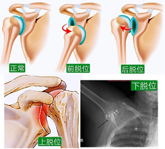 肩膀疼一个动作自测是否有肩关节脱位