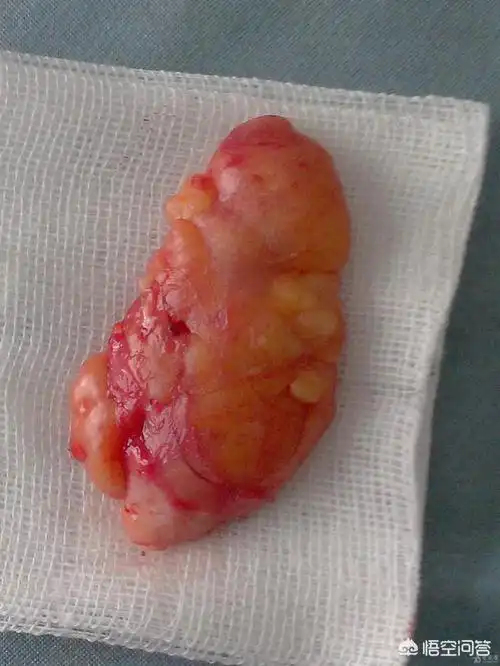 脂肪瘤有什么好的处理方法么?_尚可名片