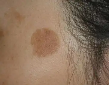 别傻傻分不清了 - 面康痣斑王