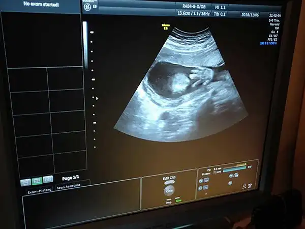 咨询!四维单上哪3个亮点能判断胎儿是男孩?