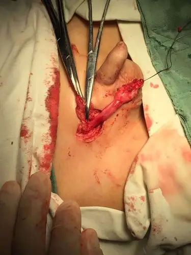 小儿隐睾下降手术