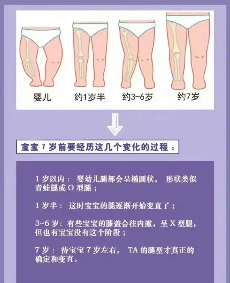 孩子o型腿正常吗?腿不直不一定是病!父母们!你们有没有担心过 - 抖音