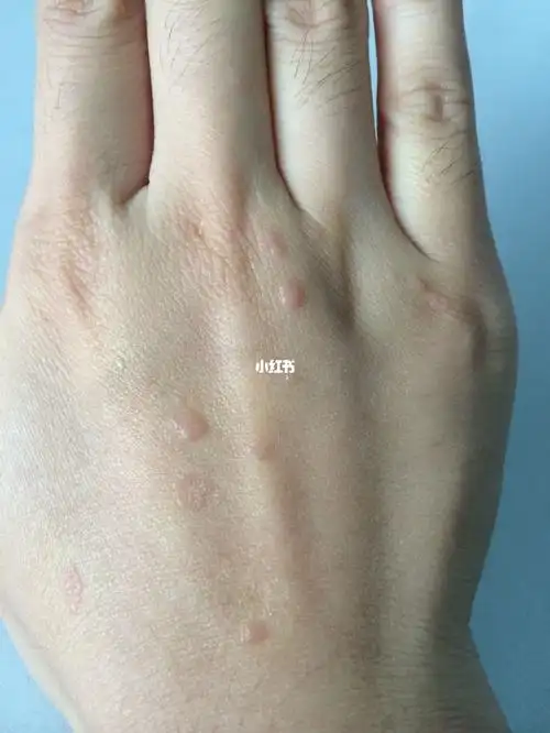 扁平疣_提高免疫力_维生素b6_代谢_补充维生素_棉签_医疗健康_医疗