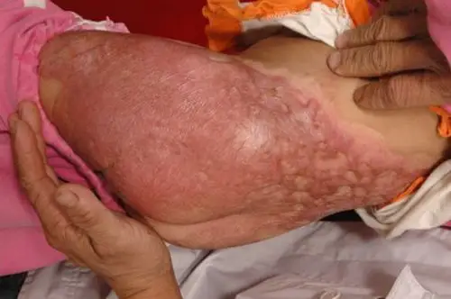 伤口深手术后增生性疤痕图片