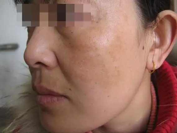 面部长黄褐斑要如何做治疗