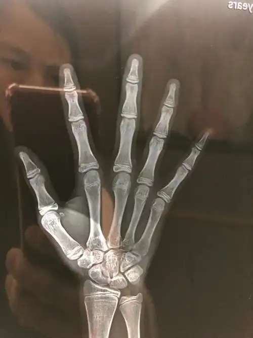 骨骺线闭没闭合对比图