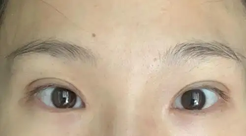 割完双眼皮20天 凹陷