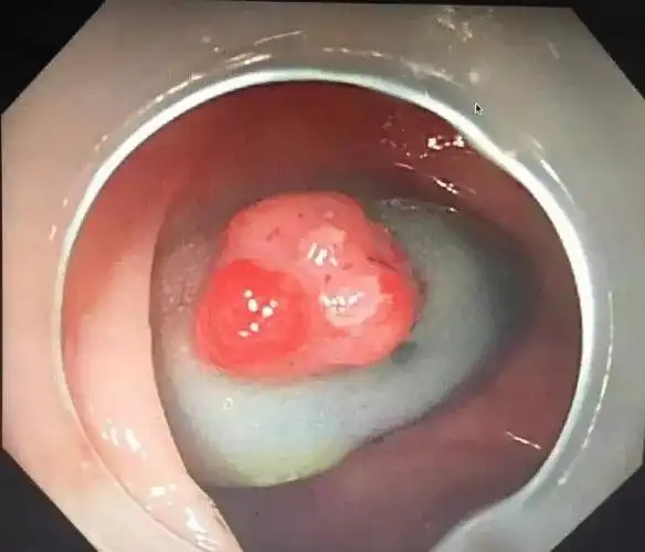 肠息肉面面观 (转载)_管状腺瘤