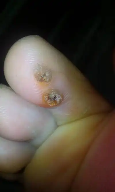 脚鸡眼图片 (3)_有来医生