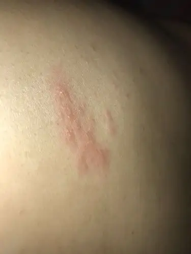 肚皮上起红色类似疙瘩.不疼也不痒.请问下这是湿疹还是什么?