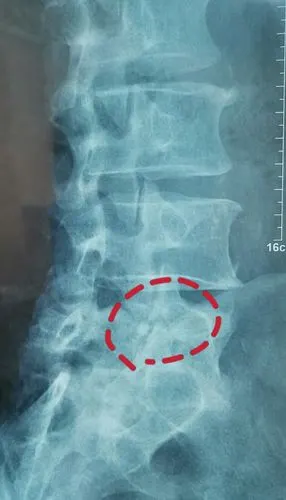 年轻人的发育不良性腰椎滑脱峡部裂应当引起重视