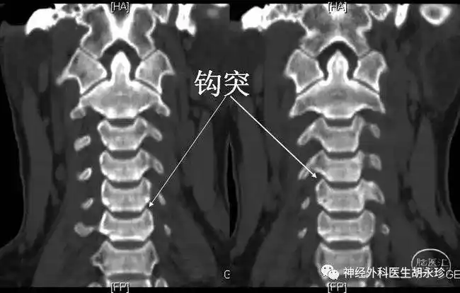 发现观察钩椎关节的最佳角度是颈椎斜位片,且可通过观察钩突骨质增生