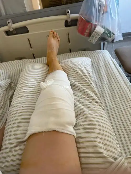 髌骨二次骨折手术