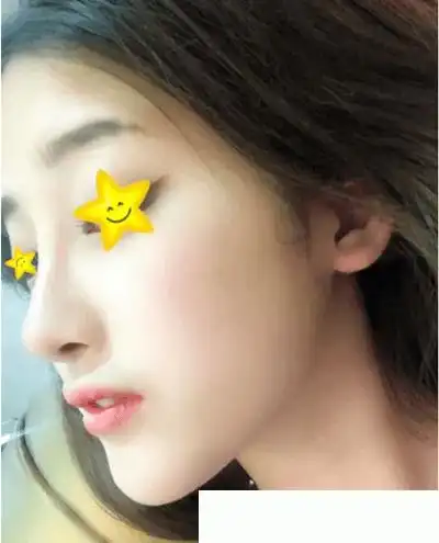 我的隆鼻日记之在西宁澳丽整形医院找李晓茹做假体隆鼻手术今天刚好