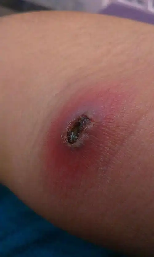 皮肤疖痊愈图片