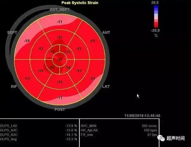 图 1 正常心肌 17 节段牛眼图根据患者症状,体征和实验室检查,无法