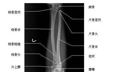尺桡骨正位x线