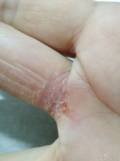 手指真菌感染怎么治疗啊?求大神 [病例帖]