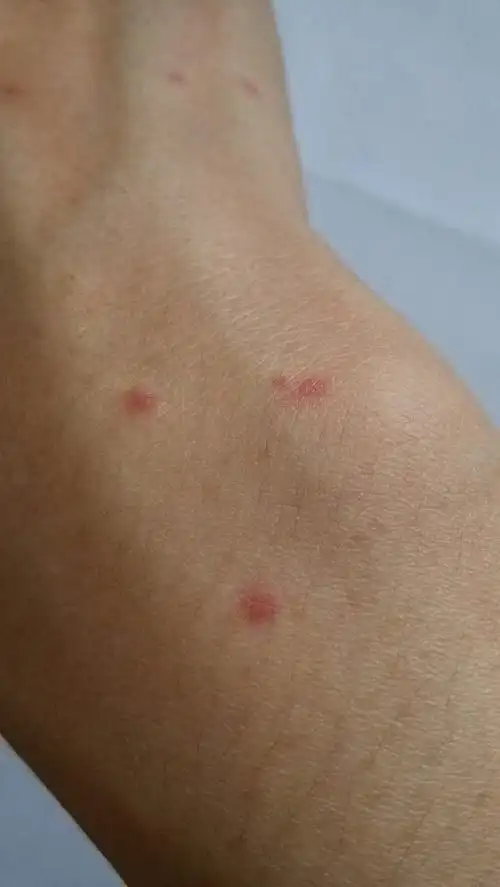 这是啥蚊子咬的么还是过敏