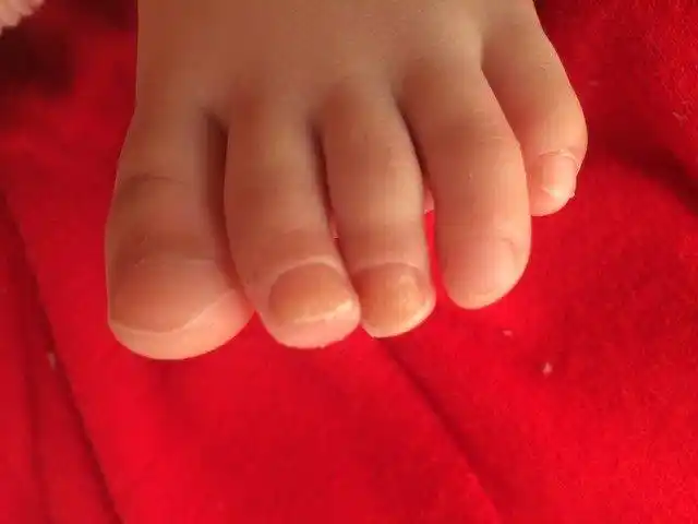 小孩脚指甲是怎么回事?