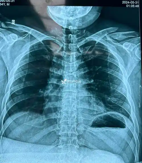 无奈的一例锁骨骨折