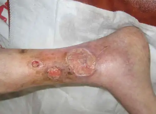 皮肤溃疡真的很严重!避免皮肤癌!