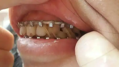 因我不小心跌倒,有侧下颌骨升支基底部骨折,无明显错位,下颌骨左侧颏