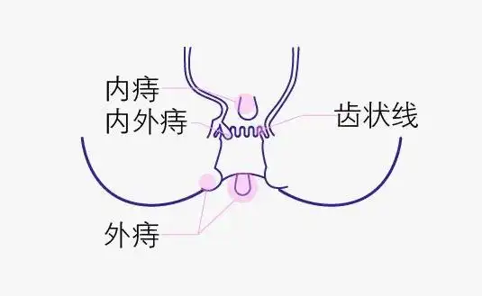 内痔疮长什么样子?