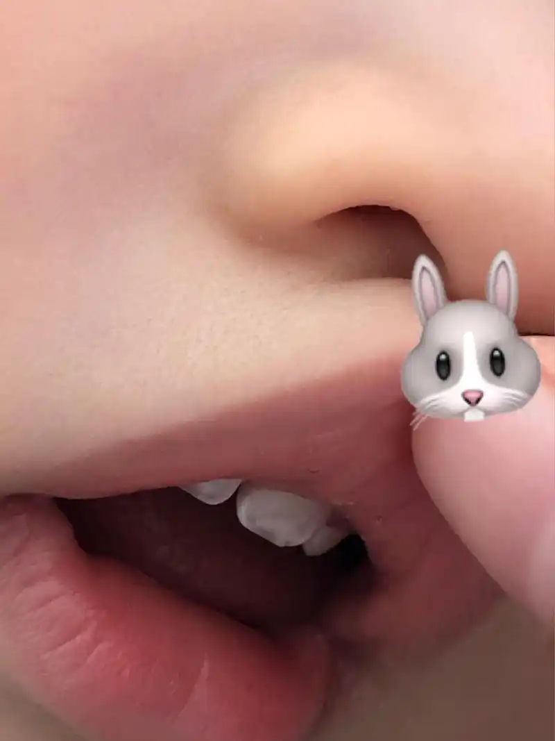 十个多月宝宝牙齿白斑是脱矿了吗?