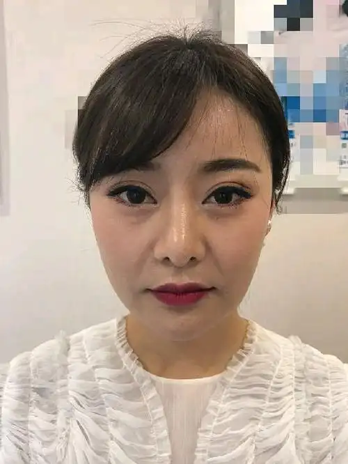 我的法令纹,破还下垂苹果肌松弛下垂图片苹果肌下垂对比脸法令整形