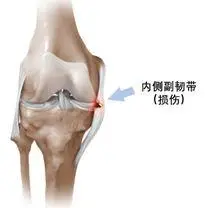 膝关节内侧副韧带损伤一定要手术么