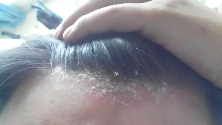 主要是头上的头屑过多,准确的说是头皮,一块一块的掉,白色.