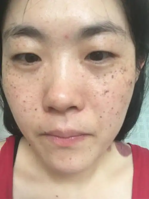 家族遗传性雀斑光子祛斑治疗中