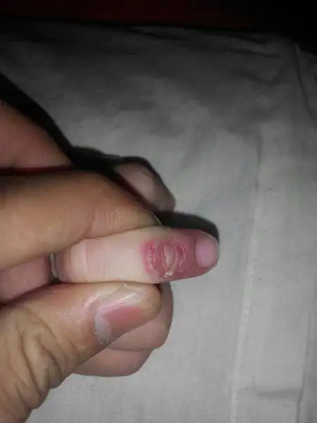 宝宝手指溃烂,干裂. 先是破皮出血,然后溃烂发炎一直不好.